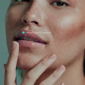 Preenchimento Labial 1ml