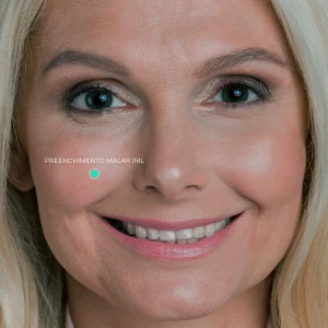 Preenchimento Malar 1ml